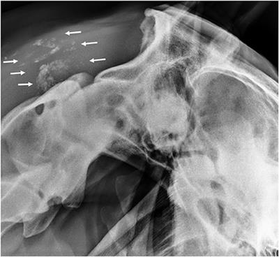 Case Report: Nuchal Bursitis Associated With Borrelia burgdorferi Infection in a Horse